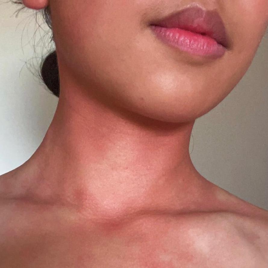 glutathione for asian glow What causes 'Asian glow'? Here's how to recognize the symptoms JOYN Supplement Value Pack: Alcohol