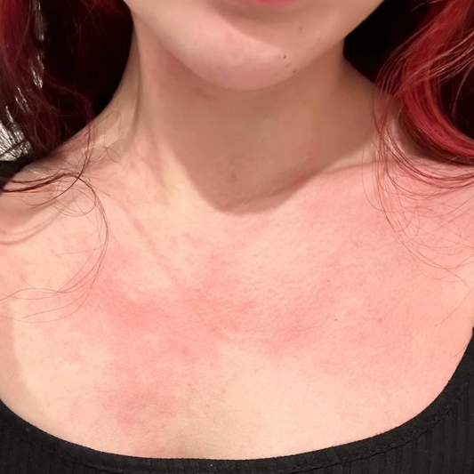 ALDH2 Deficiency — What It Is, Who Has It, and What It Means for Your Drinking