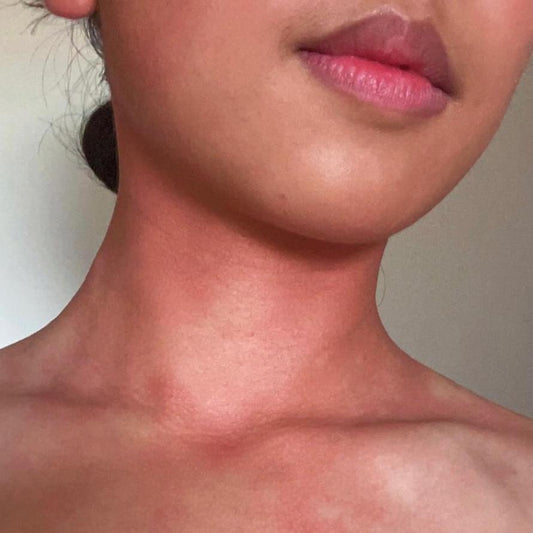 How Severe Is My Asian Flush? Find Out Where You Sit and How to Manage It